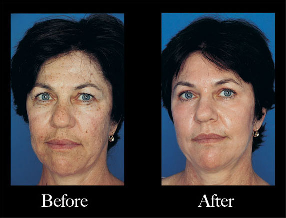 Obagi blue peel deals