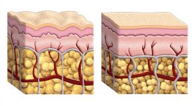 Dermis before and after