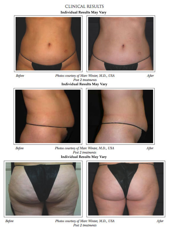 Cellulite Smoothing Treatment