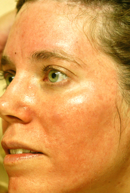 Acne Scars Treatment After Photo