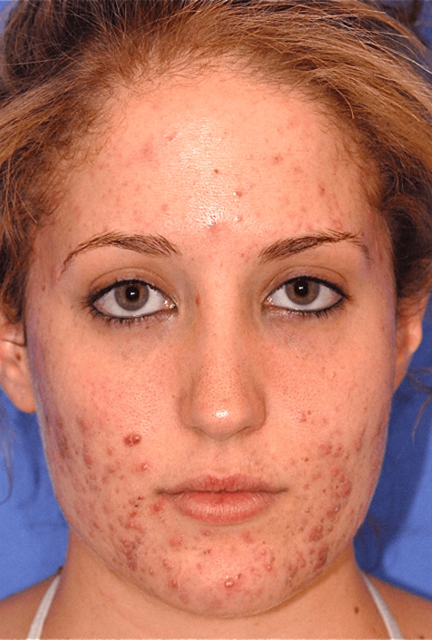 Acne Treatment Before Photo
