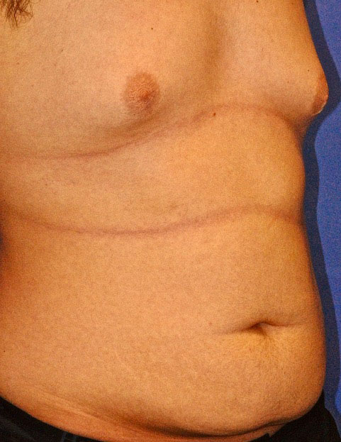 CoolSculpting ELITE Fat Reduction near Gilbert, Mesa, Chandler