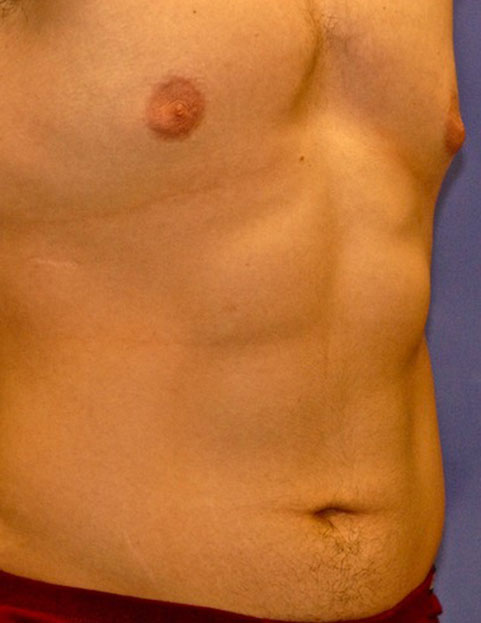 CoolSculpting