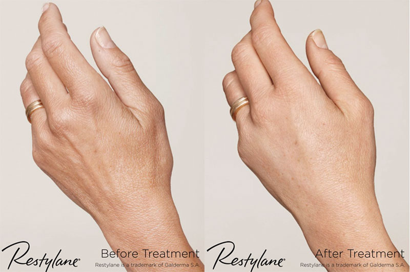 Restylane for Hands