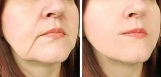 liquid facelift before and after