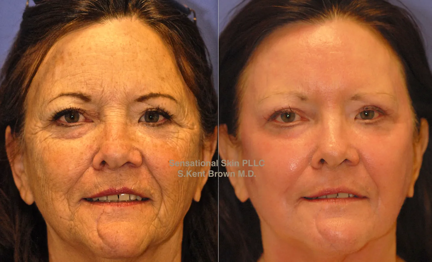 bxa CO2 Max Laser procedure