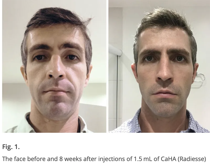 before and after CaHa Radiesse