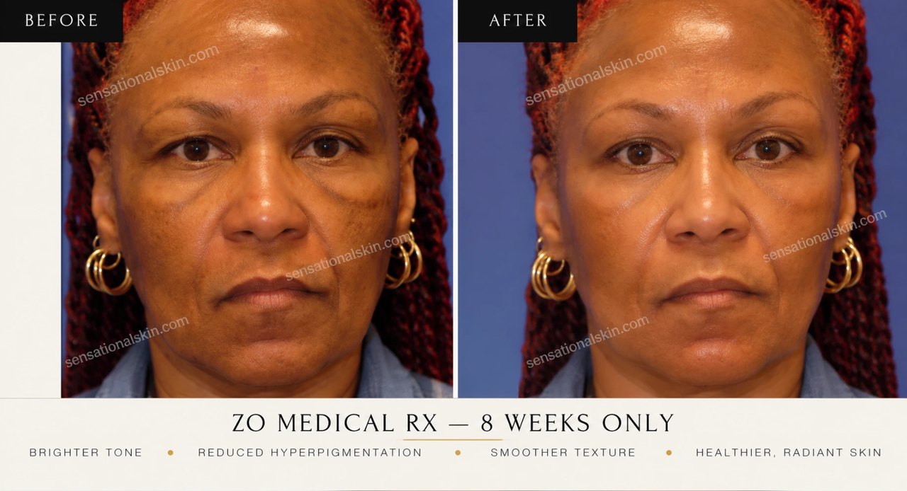 Before and after: ZO Medical Rx, 8 weeks, Sensational Skin patient