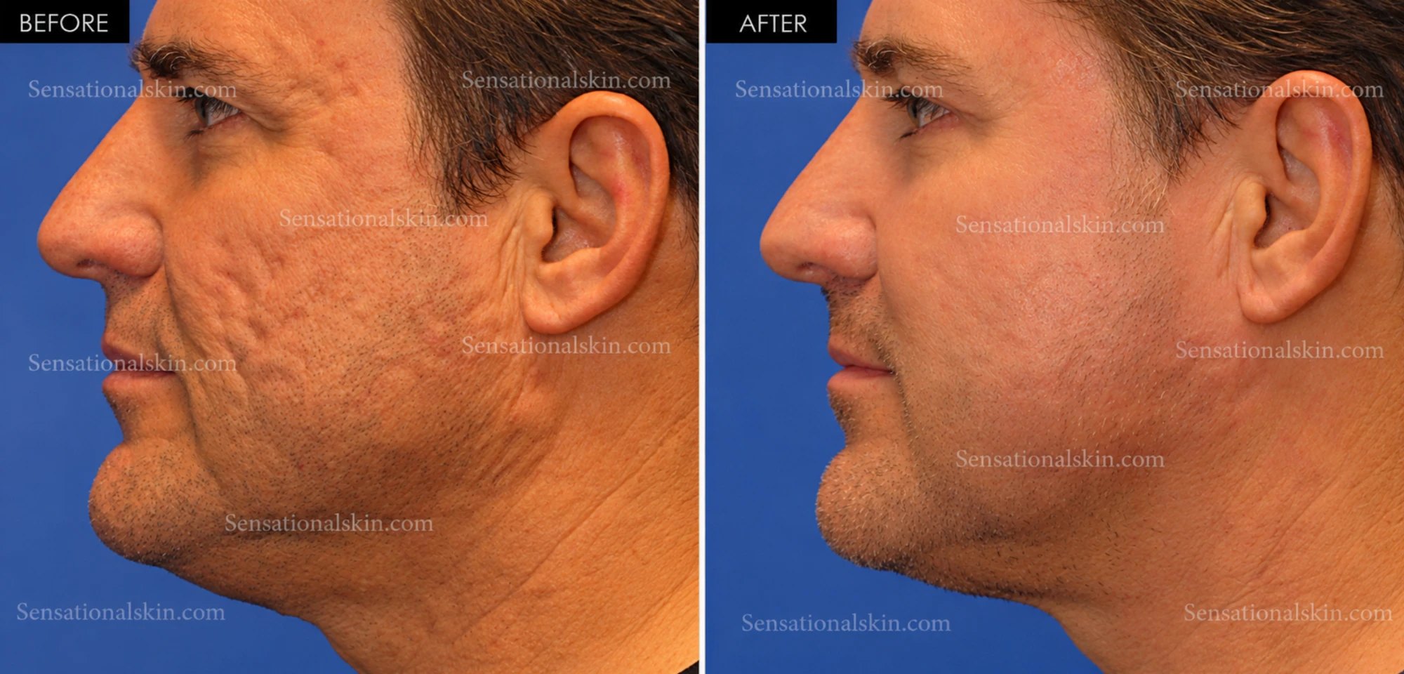 Before and after: Acne scar treatment, Sensational Skin patient