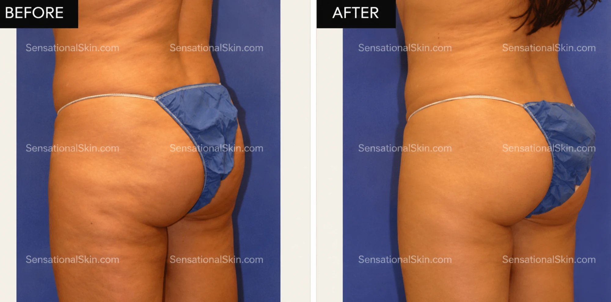 Before and after: Body contouring, Sensational Skin patient