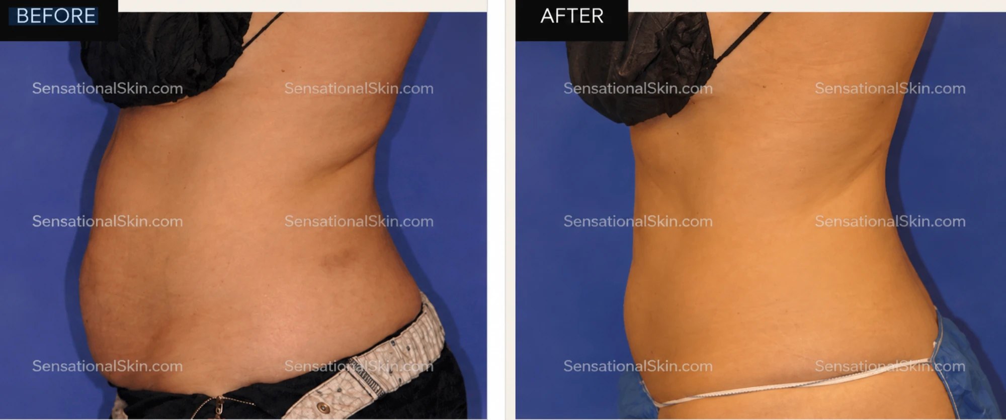 Before and after: Body contouring, Sensational Skin patient