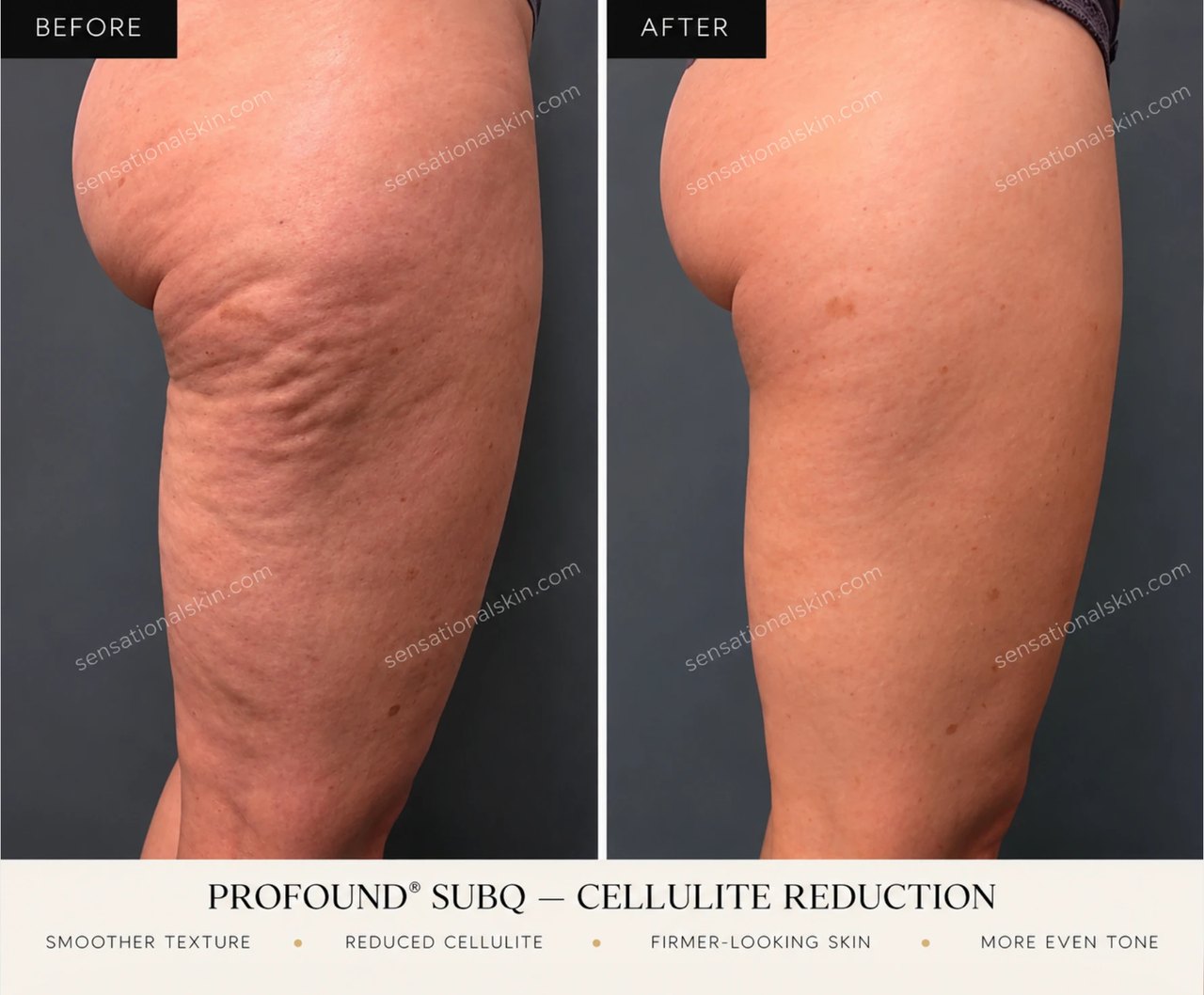 Before and after: Profound SubQ cellulite treatment, thigh, Sensational Skin patient