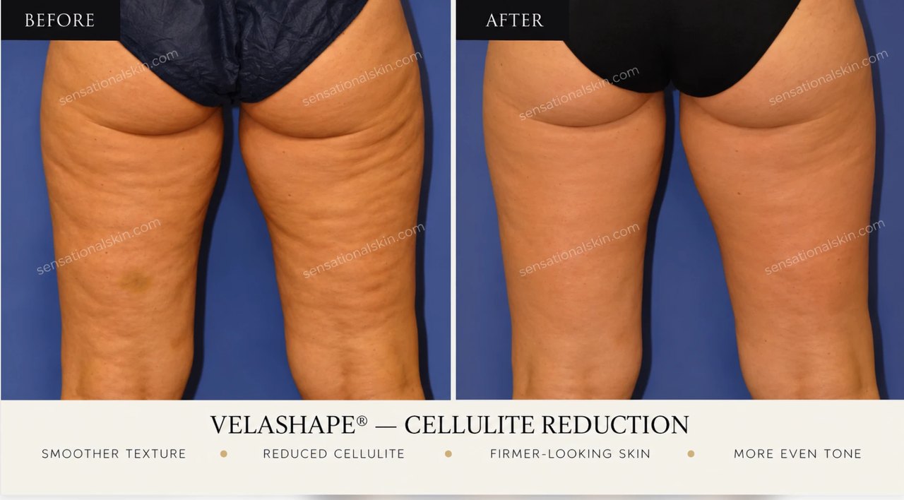 Before and after: VelaShape cellulite treatment, back of thighs, Sensational Skin patient