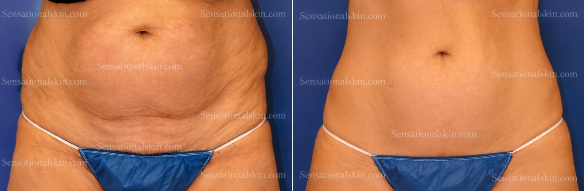 Before and after: CoolSculpting abdomen, Sensational Skin patient