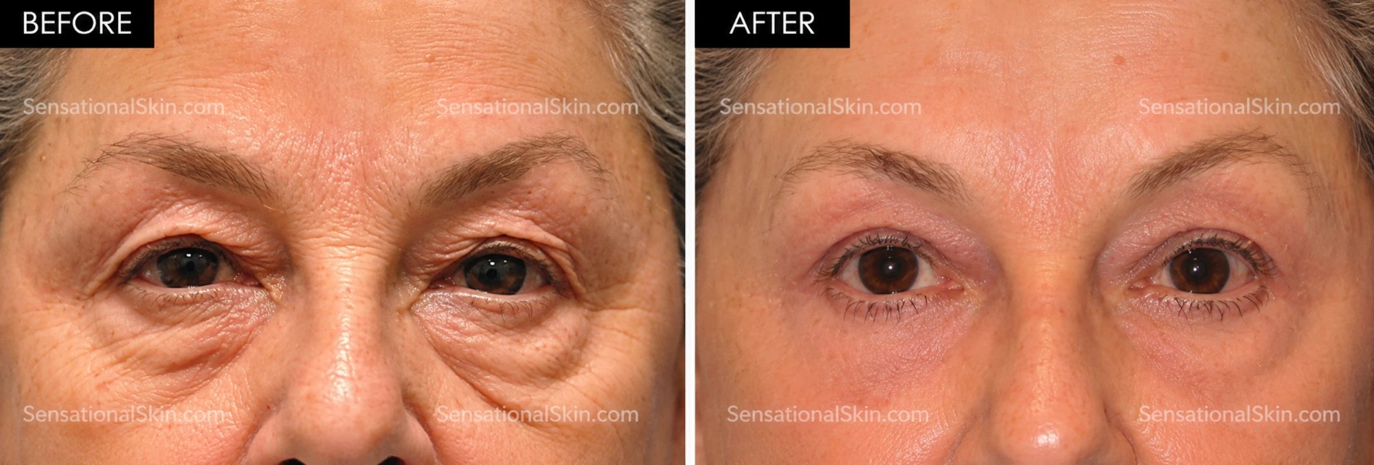 Before and after: Laser eyelid lift, Sensational Skin patient
