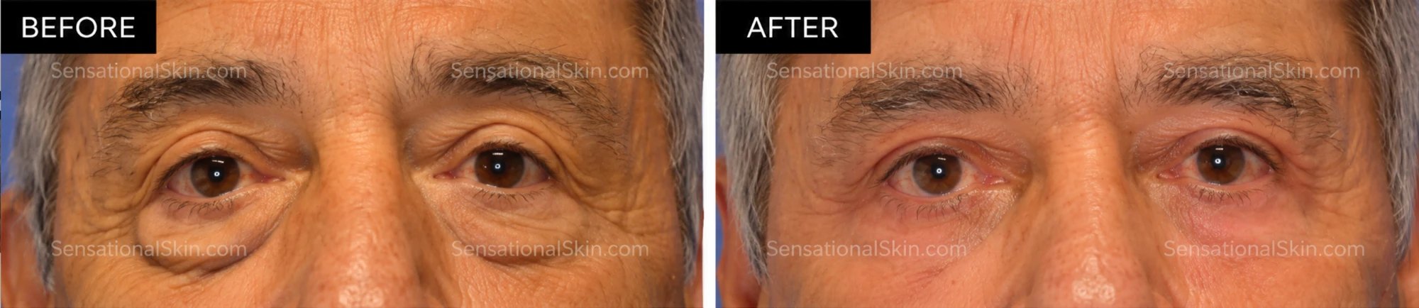 Before and after: Laser eyelid lift, Sensational Skin patient