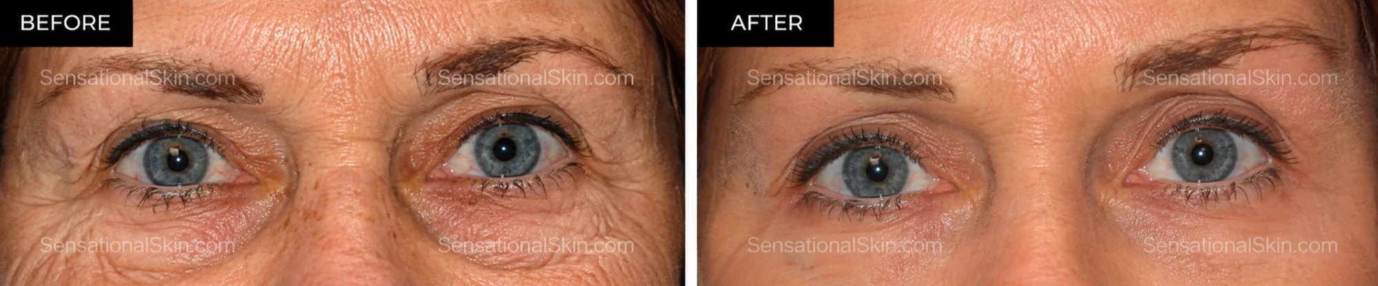 Before and after: Laser eyelid lift, Sensational Skin patient