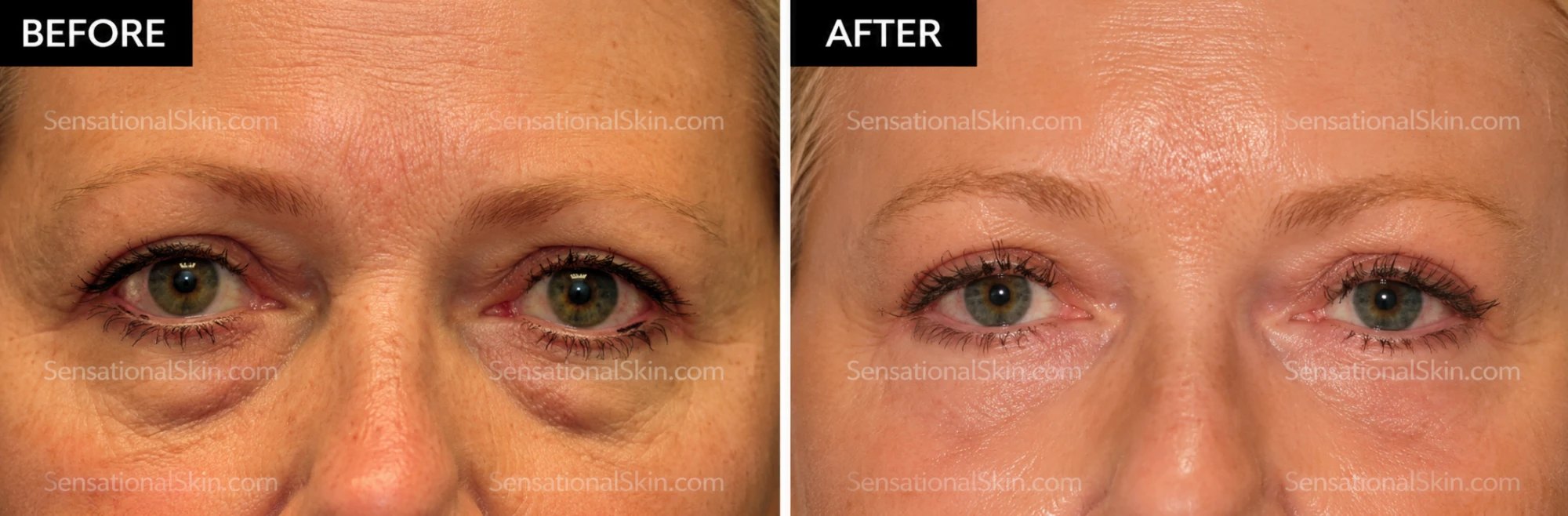 Before and after: Laser eyelid lift, Sensational Skin patient