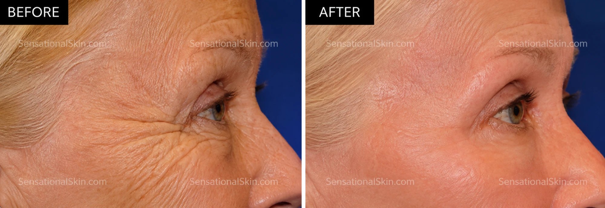 Before and after: Laser eyelid lift, Sensational Skin patient