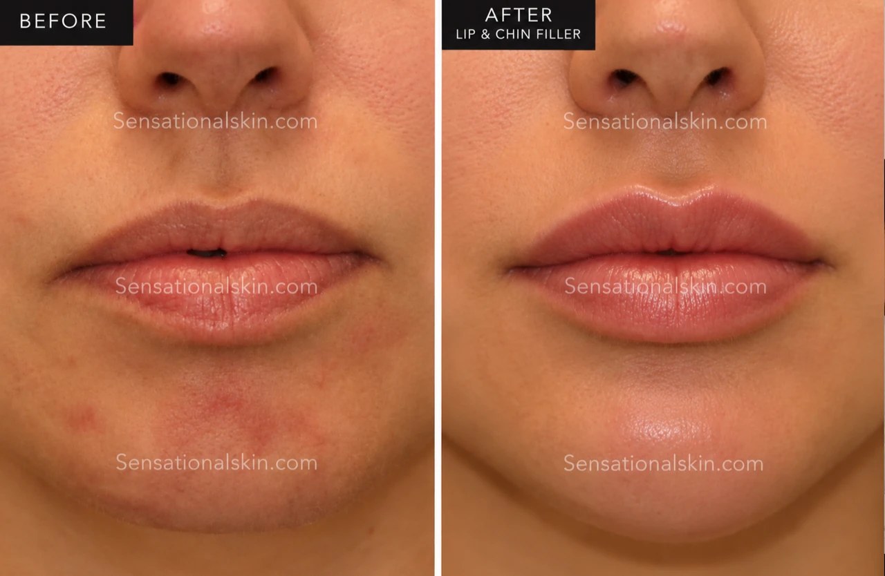 Before and after: Lip and chin filler, Sensational Skin patient
