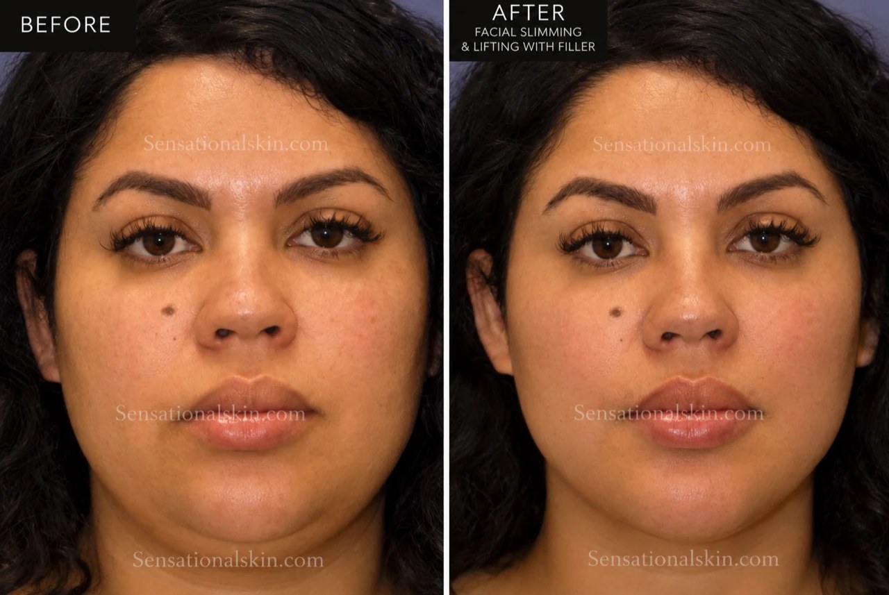 Before and after: Facial slimming and lifting with filler, Sensational Skin patient