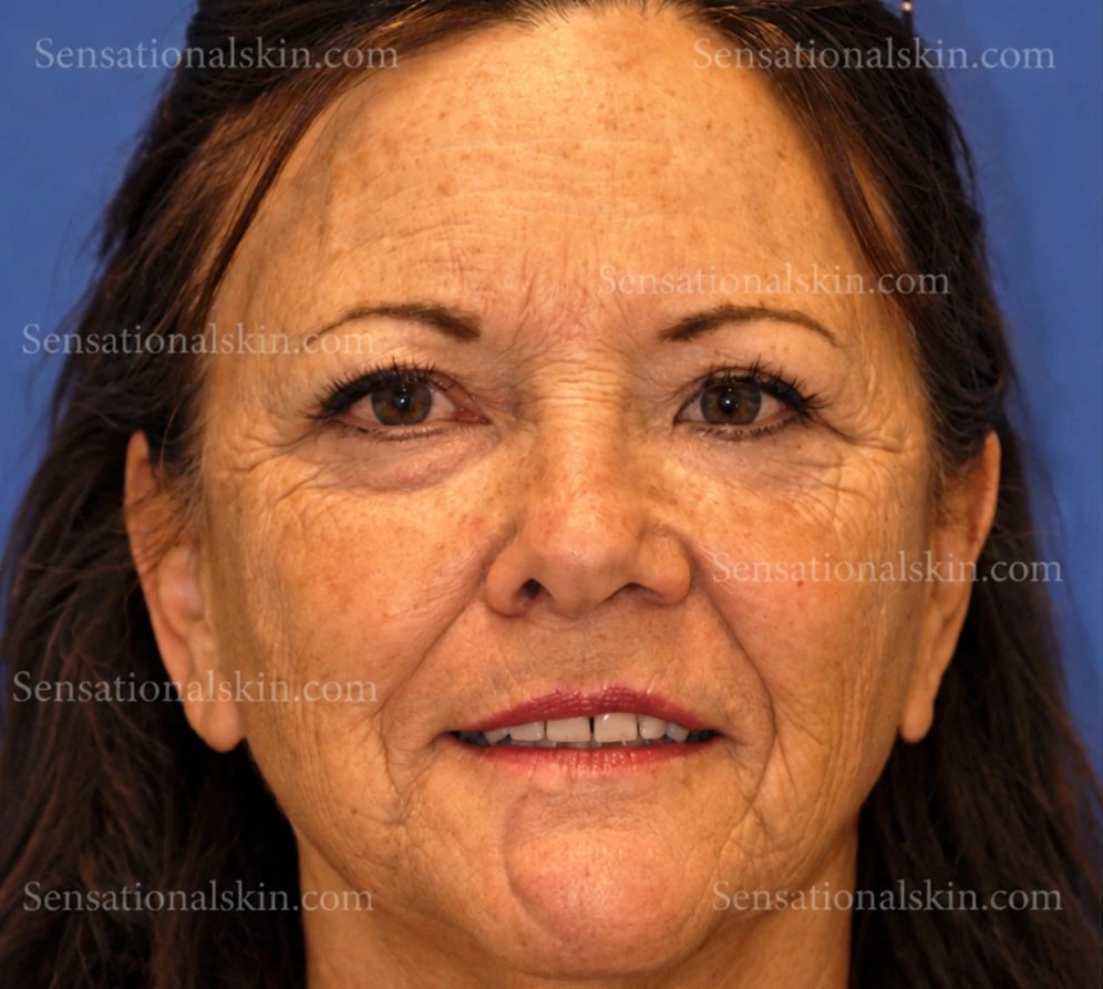 Before treatment