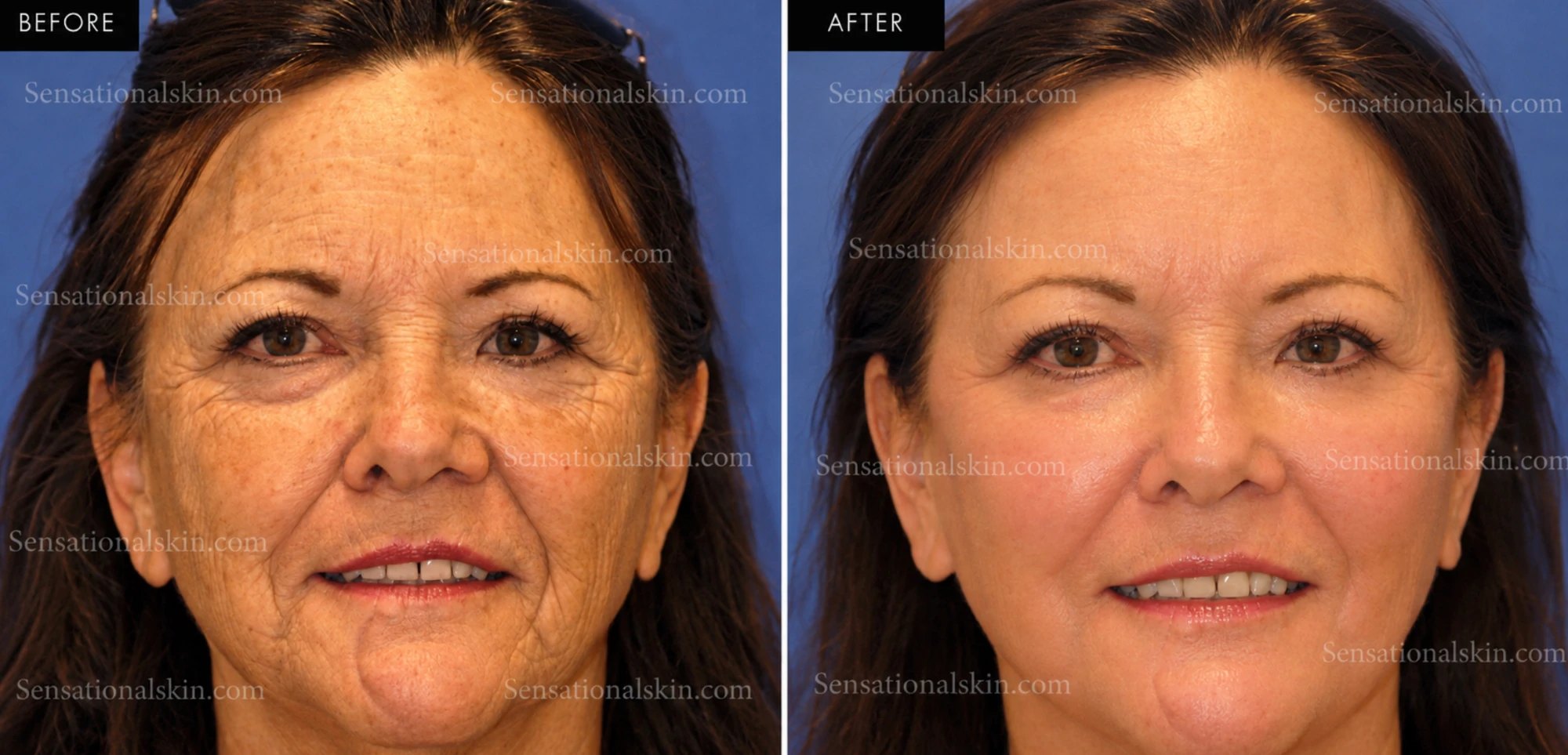 Before and after: Laser resurfacing, Sensational Skin patient