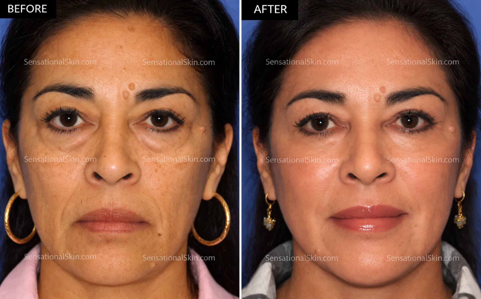 Before and after: Liquid facelift, Sensational Skin patient