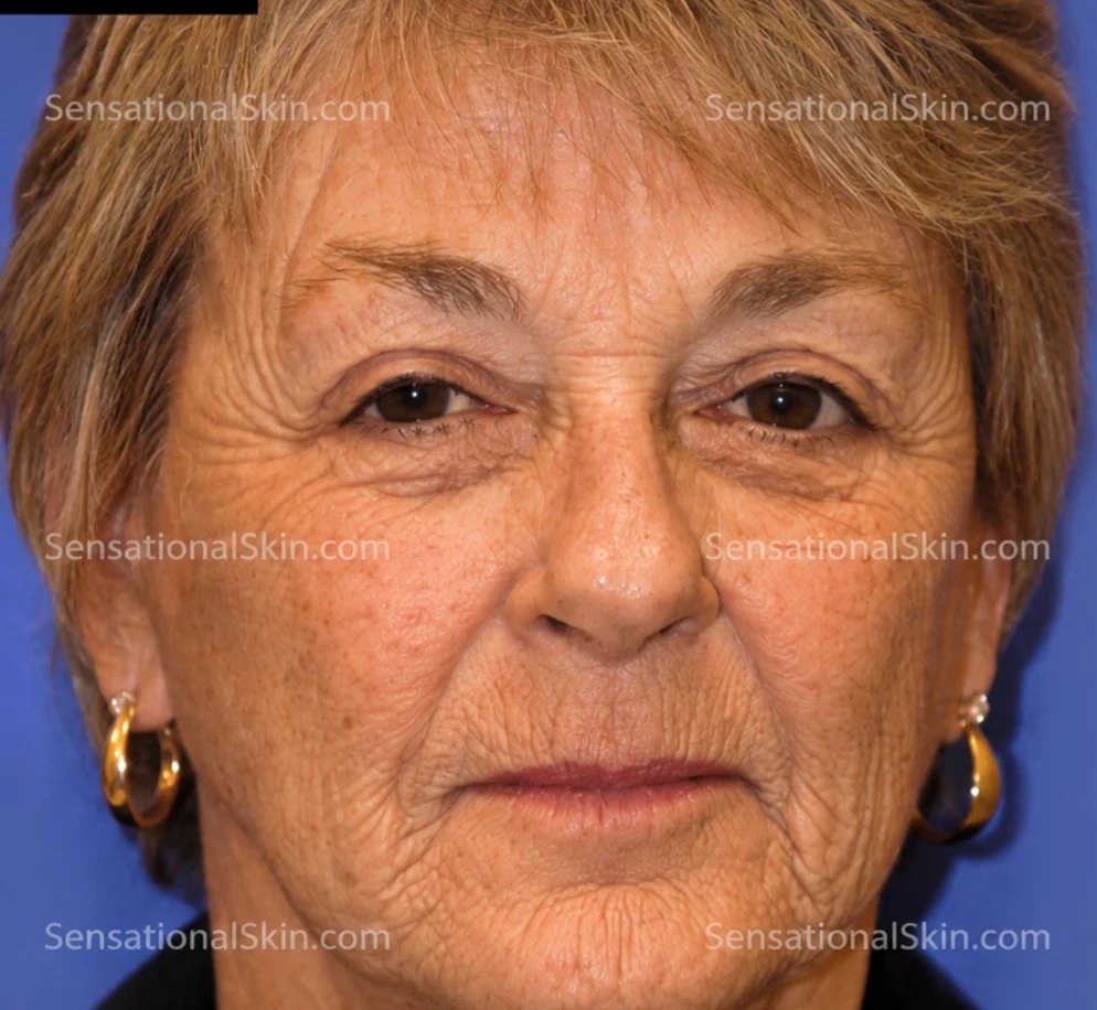 Before Liquid Facelift