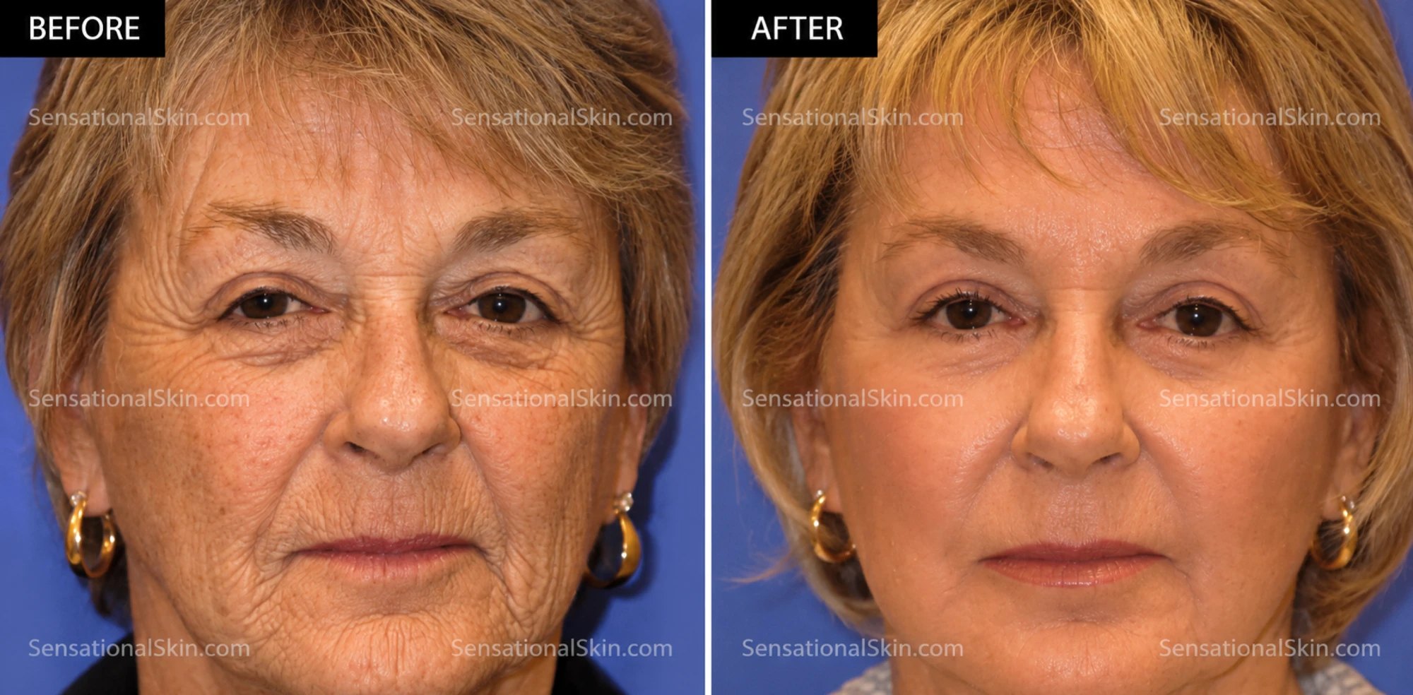 Before and after: Liquid facelift, Sensational Skin patient