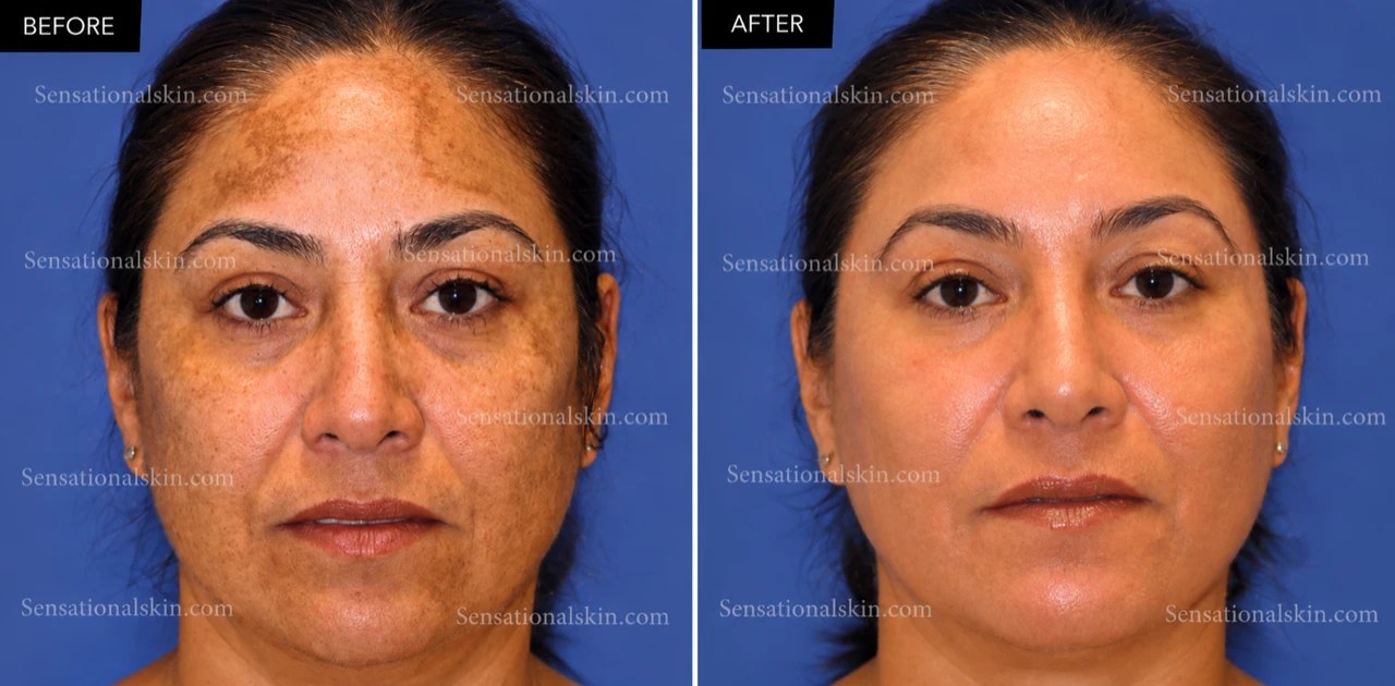 Before and after: Pigmentation treatment, Sensational Skin patient
