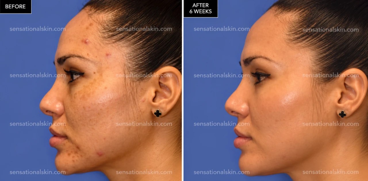 Before and after: Pigmentation treatment, Sensational Skin patient