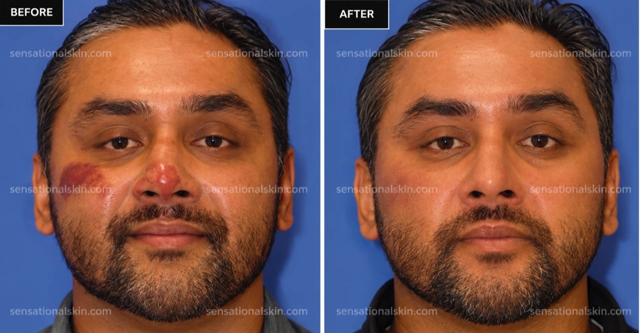 Before and after: Pigmentation treatment, Sensational Skin patient