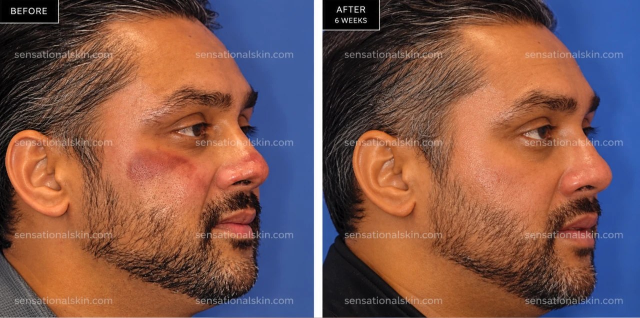 Before and after: Pigmentation treatment, Sensational Skin patient