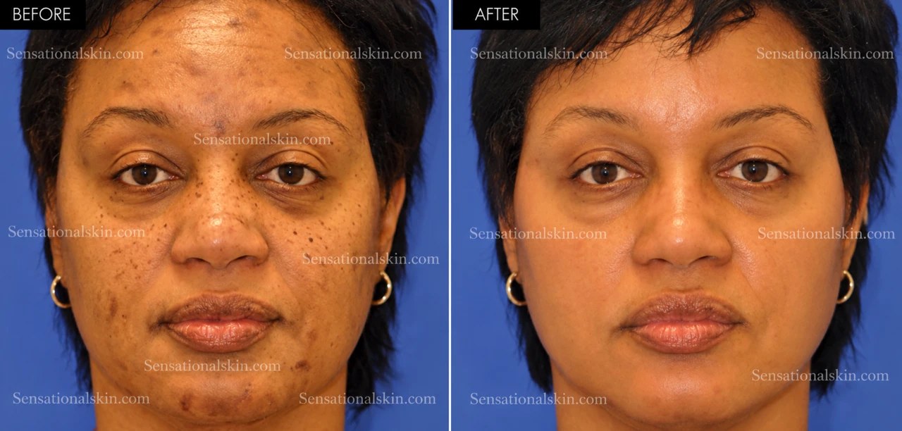 Before and after: Pigmentation treatment, Sensational Skin patient