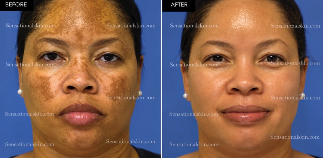 Before and after: Pigmentation treatment, Sensational Skin patient