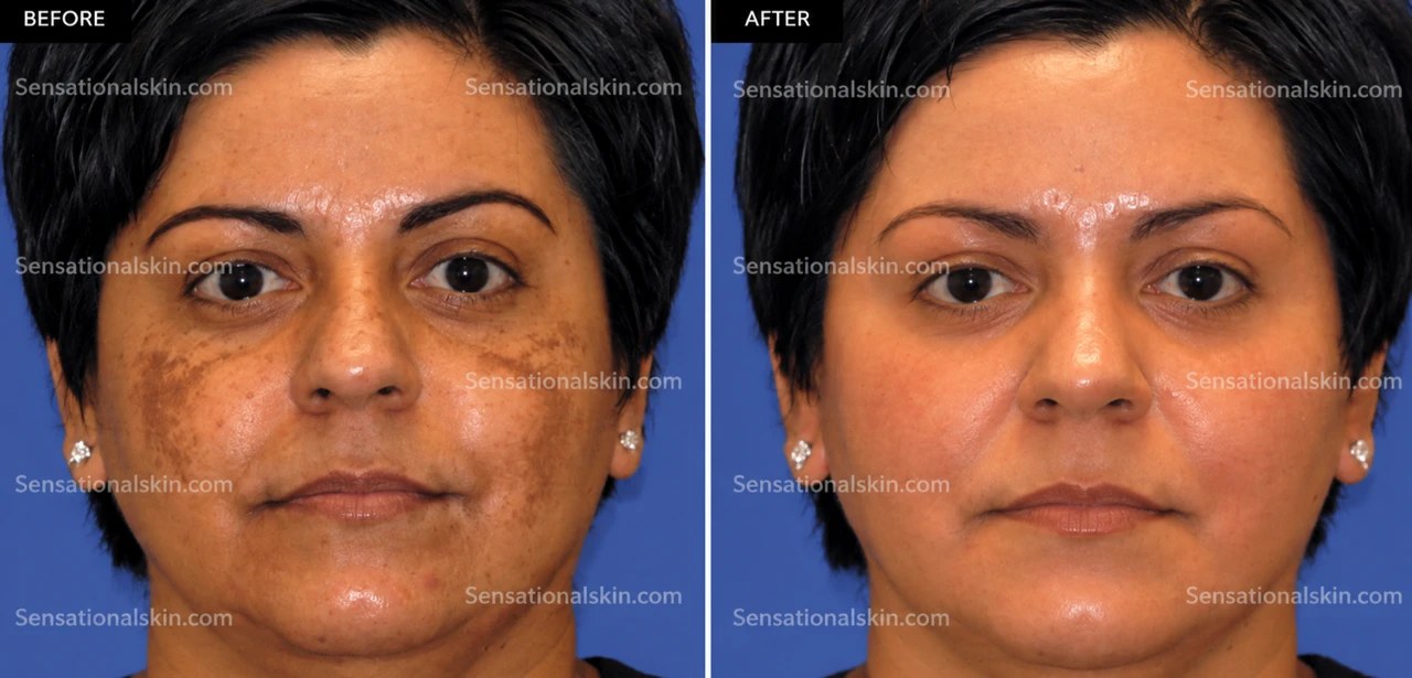 Before and after: Pigmentation treatment, Sensational Skin patient