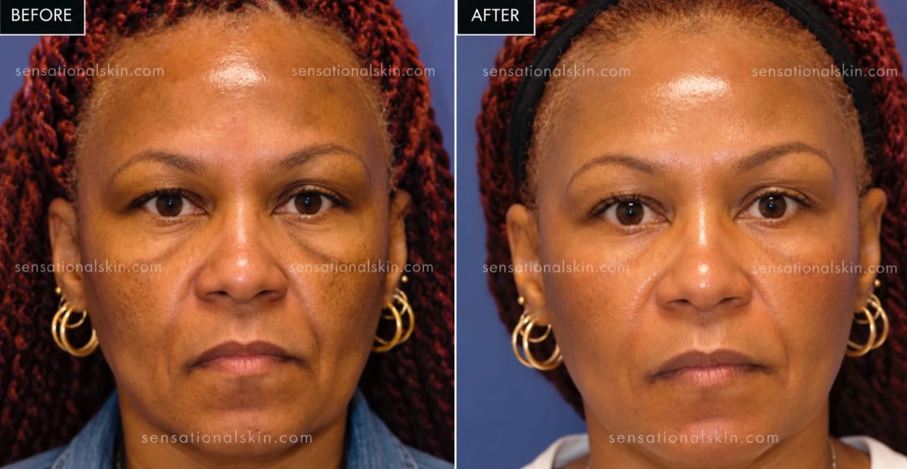 Before and after: Pigmentation treatment, Sensational Skin patient