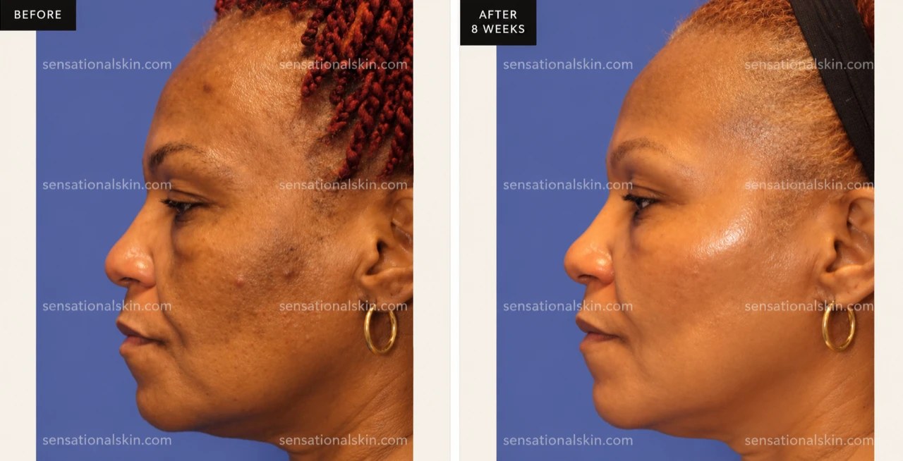 Before and after: Pigmentation treatment, Sensational Skin patient