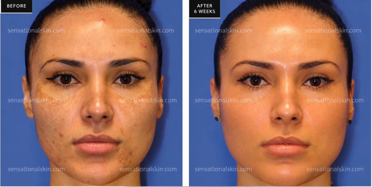 Before and after: Pigmentation treatment, Sensational Skin patient