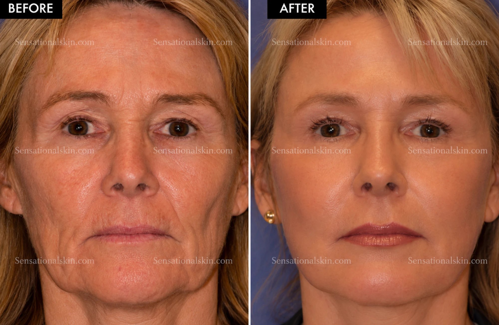 Before and after: Sagging skin treatment, Sensational Skin patient