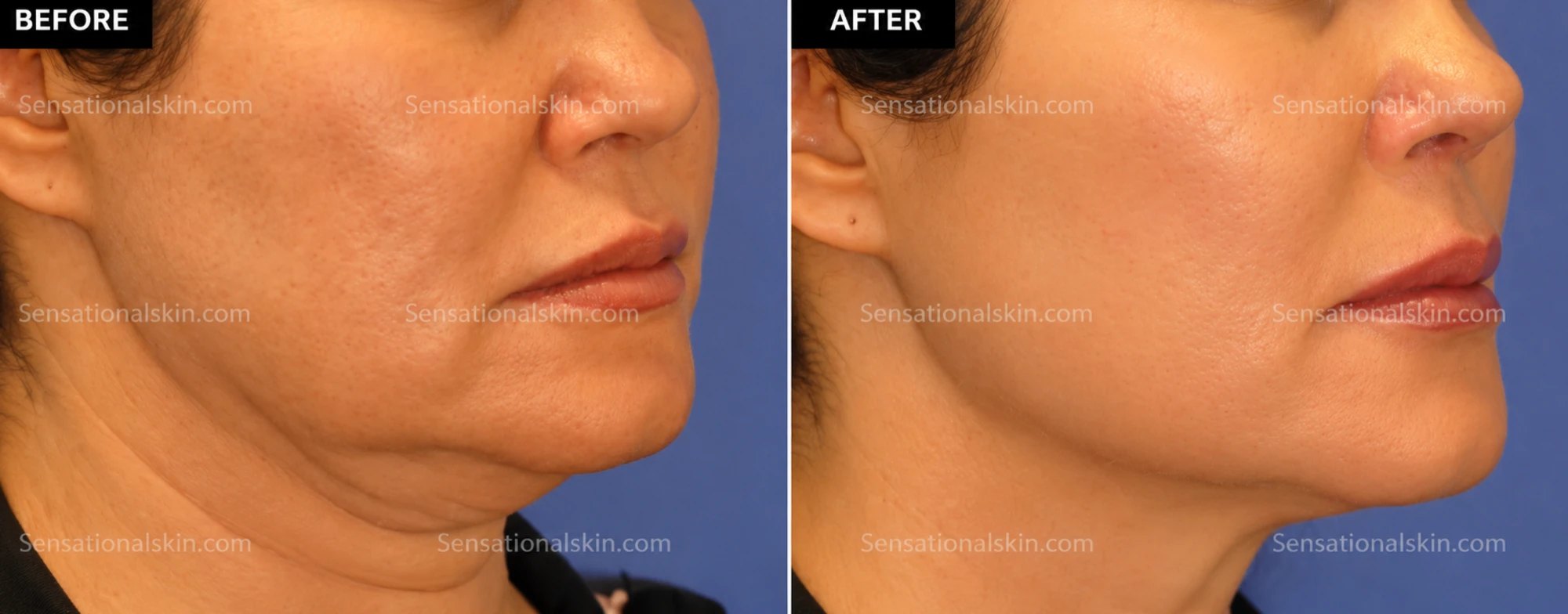 Before and after: Sagging skin treatment, Sensational Skin patient