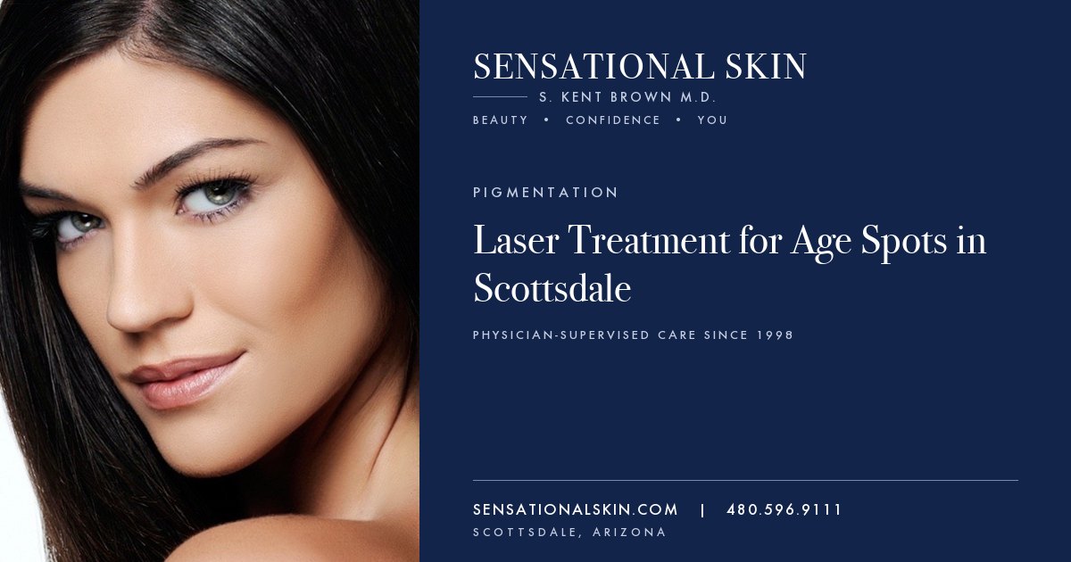 Laser Treatment for Age Spots in Scottsdale, Sensational Skin, Scottsdale