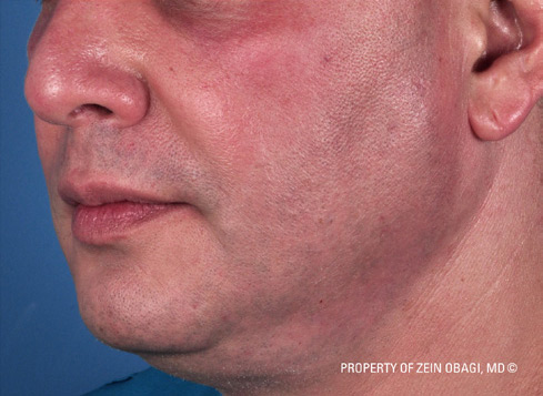 Patient 2 after photo of Large Pores patient at Sensational Skin Scottsdale