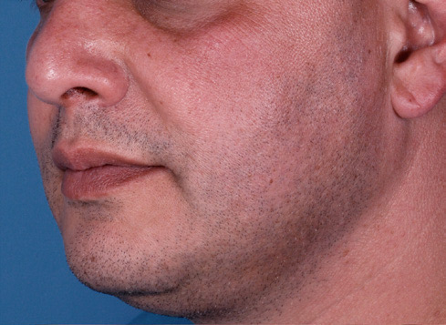 Patient 2 before photo of Large Pores patient at Sensational Skin Scottsdale