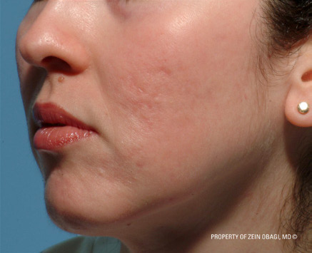 Patient 7 after photo of Acne Scars patient at Sensational Skin Scottsdale
