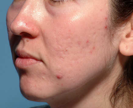 Patient 7 before photo of Acne Scars patient at Sensational Skin Scottsdale