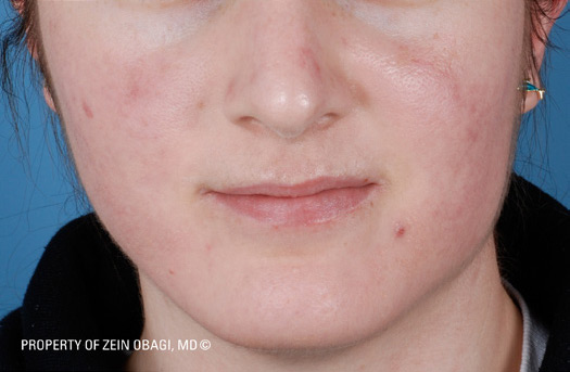Patient 9 after photo of Acne Scars patient at Sensational Skin Scottsdale