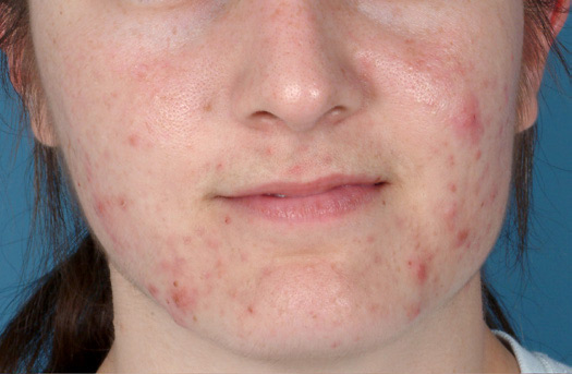 Patient 9 before photo of Acne Scars patient at Sensational Skin Scottsdale