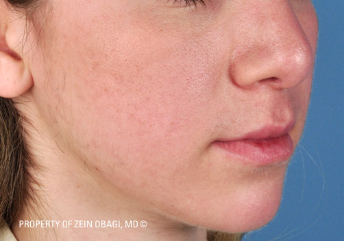 Patient 10 after photo of Acne Scars patient at Sensational Skin Scottsdale
